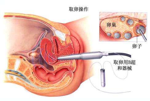 试管婴儿具体步骤