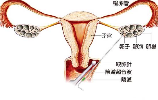 女性取卵