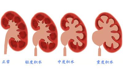 试管女性积水